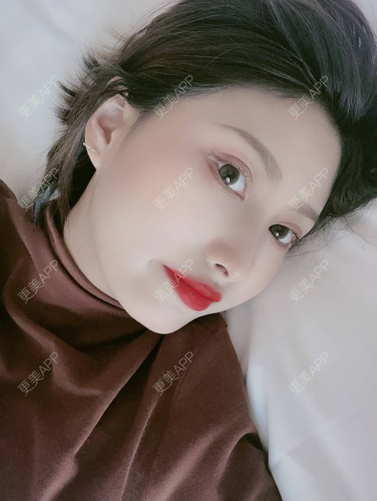 更美 - 更美用户JpxuFzIkAJ的鼻部多项经验 | 广州 | 视频日记 | 鼻部多项