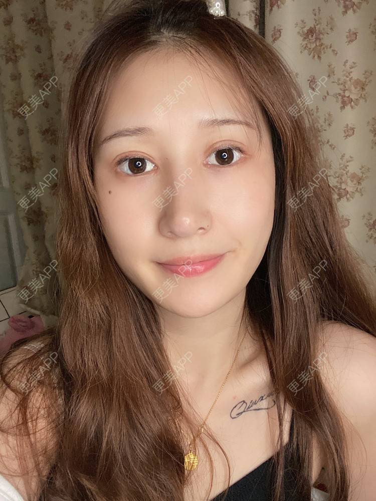 更美 - 真心已售完谝的定点双眼皮经验 | 北京 | 定点双眼皮