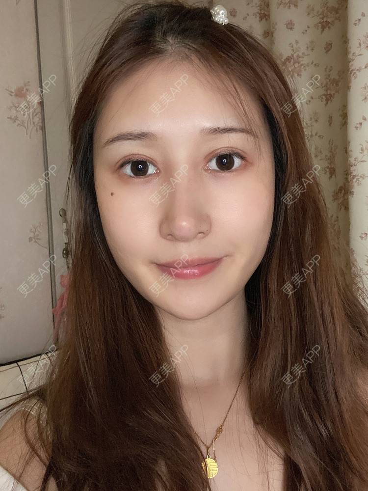 更美 - 真心已售完谝的定点双眼皮经验 | 北京 | 定点双眼皮