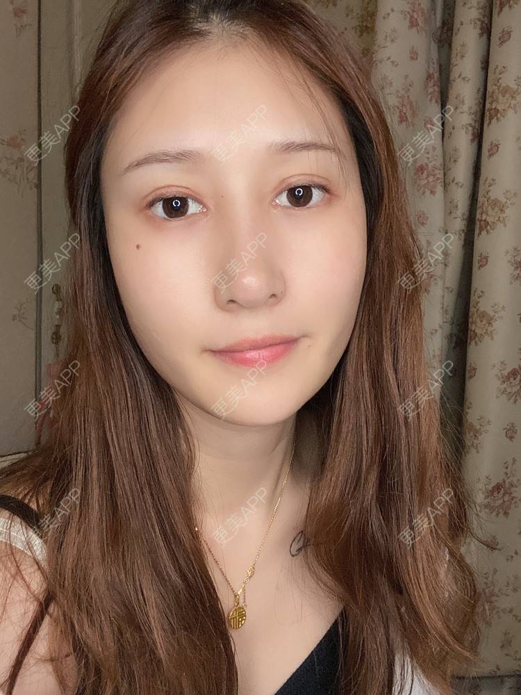 更美 - 真心已售完谝的定点双眼皮经验 | 北京 | 定点双眼皮