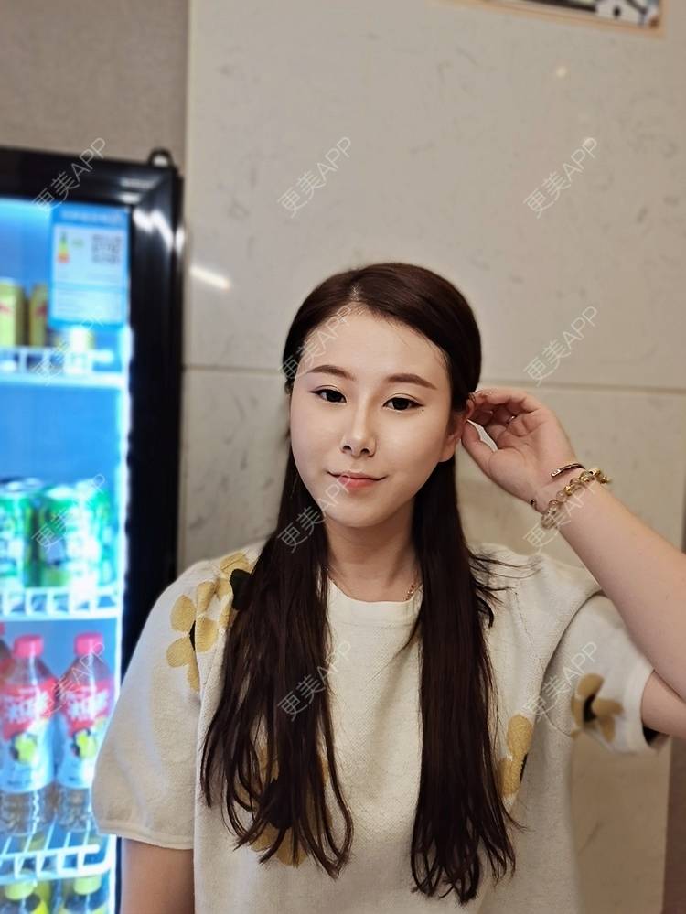 更美 - 更美用户YzIgvthL7D的耳软骨隆鼻经验 | 郑州 | 耳软骨隆鼻