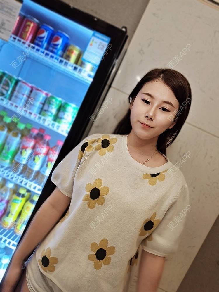 更美 - 更美用户YzIgvthL7D的耳软骨隆鼻经验 | 郑州 | 耳软骨隆鼻