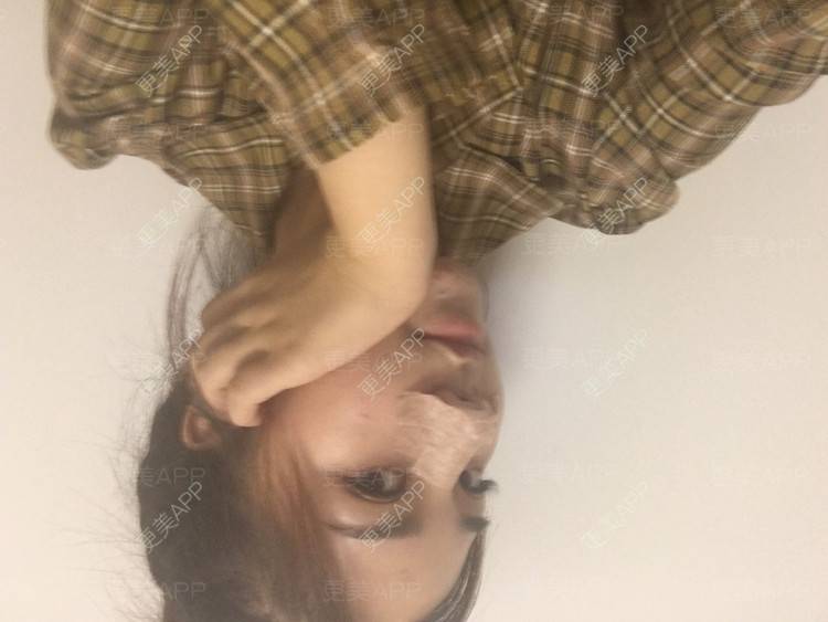 更美 - 爱不换富的鼻部多项经验 | 鼻部多项 | 自体软骨垫鼻尖 | 耳软骨隆鼻 | 膨体隆鼻 | 肋软骨隆鼻 | 成都
