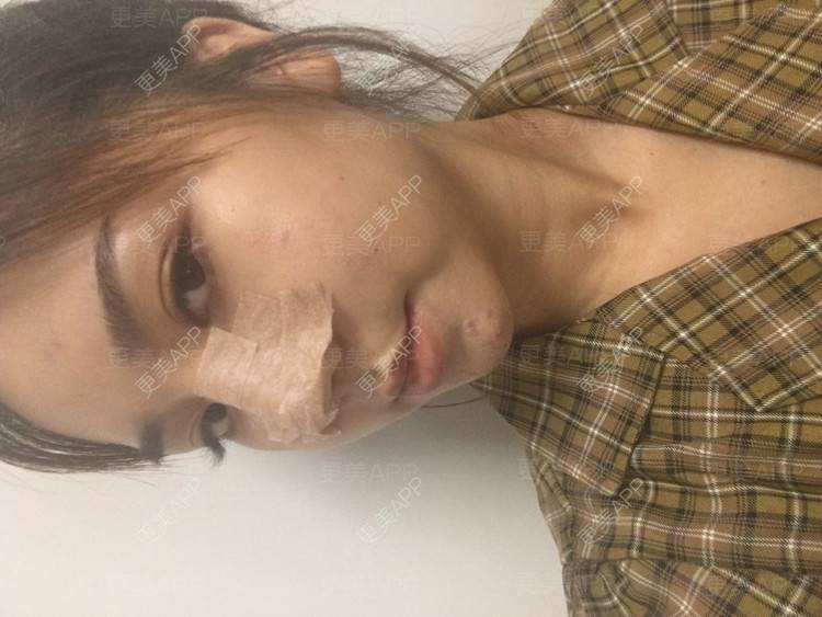 更美 - 爱不换富的鼻部多项经验 | 鼻部多项 | 自体软骨垫鼻尖 | 耳软骨隆鼻 | 膨体隆鼻 | 肋软骨隆鼻 | 成都
