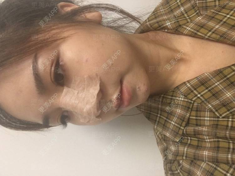 更美 - 爱不换富的鼻部多项经验 | 鼻部多项 | 自体软骨垫鼻尖 | 耳软骨隆鼻 | 膨体隆鼻 | 肋软骨隆鼻 | 成都