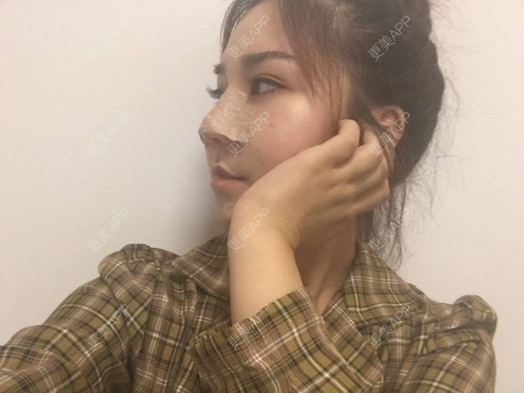 更美 - 爱不换富的鼻部多项经验 | 鼻部多项 | 自体软骨垫鼻尖 | 耳软骨隆鼻 | 膨体隆鼻 | 肋软骨隆鼻 | 成都