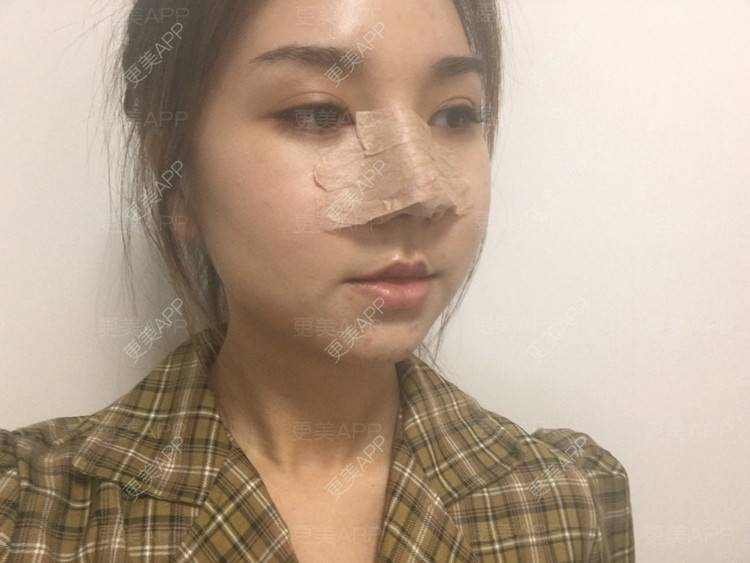 更美 - 爱不换富的鼻部多项经验 | 鼻部多项 | 自体软骨垫鼻尖 | 耳软骨隆鼻 | 膨体隆鼻 | 肋软骨隆鼻 | 成都