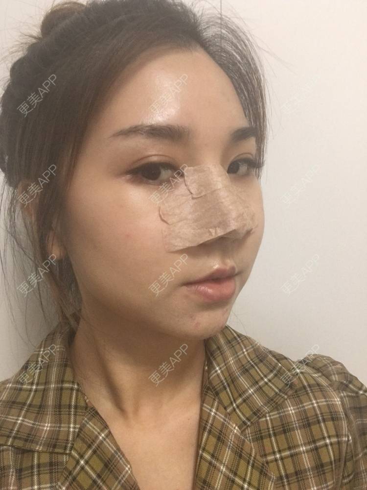 更美 - 爱不换富的鼻部多项经验 | 鼻部多项 | 自体软骨垫鼻尖 | 耳软骨隆鼻 | 膨体隆鼻 | 肋软骨隆鼻 | 成都