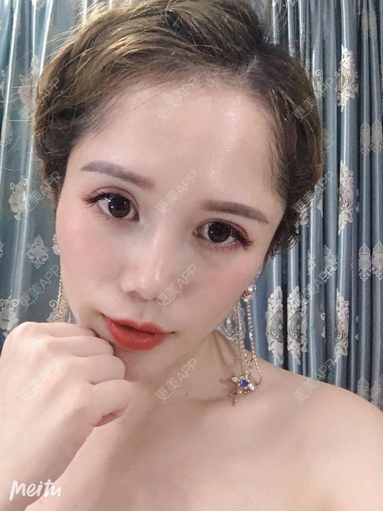 更美 - 更美用户RFLSjrNOjT的硅胶丰太阳穴经验 | 硅胶丰太阳穴 | 膨体丰太阳穴 | 太阳穴 | 郑州