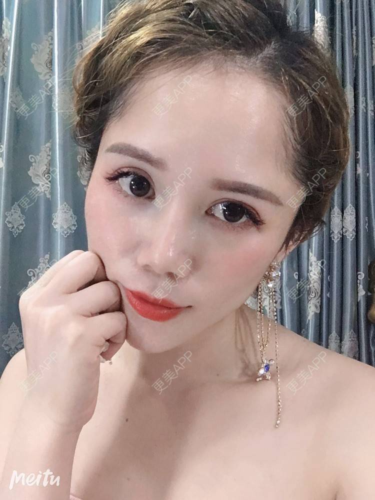 更美 - 更美用户RFLSjrNOjT的硅胶丰太阳穴经验 | 硅胶丰太阳穴 | 膨体丰太阳穴 | 太阳穴 | 郑州