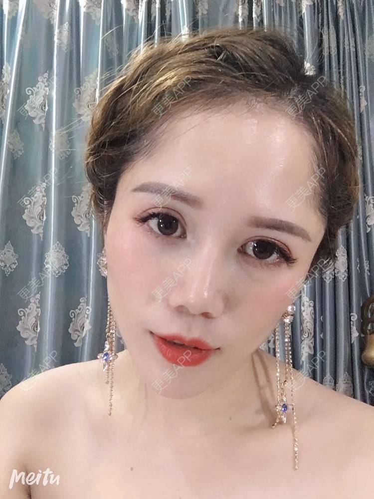 更美 - 更美用户RFLSjrNOjT的硅胶丰太阳穴经验 | 硅胶丰太阳穴 | 膨体丰太阳穴 | 太阳穴 | 郑州