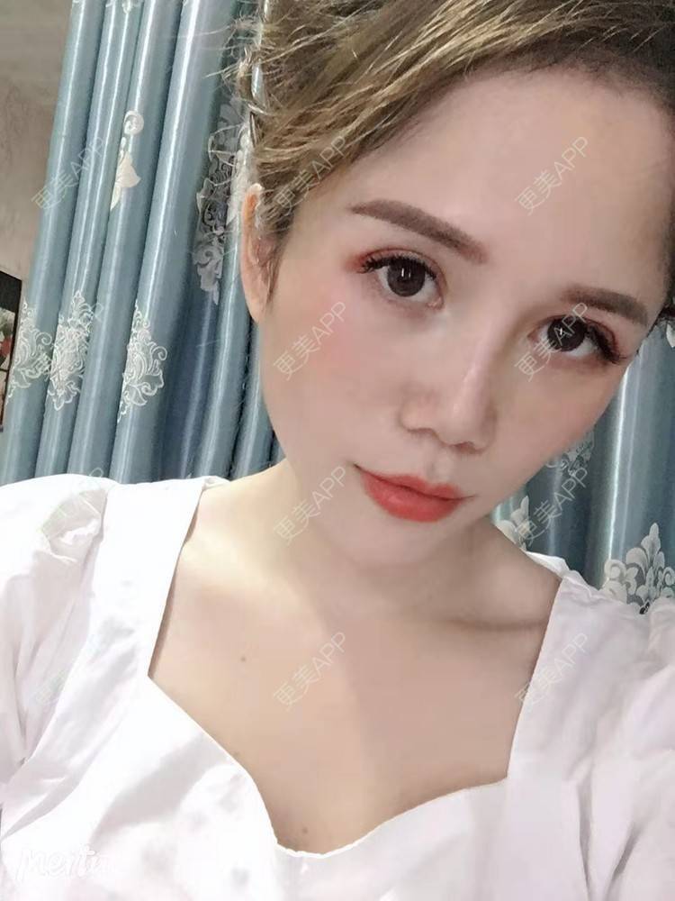 更美 - 更美用户RFLSjrNOjT的硅胶丰太阳穴经验 | 硅胶丰太阳穴 | 膨体丰太阳穴 | 太阳穴 | 郑州