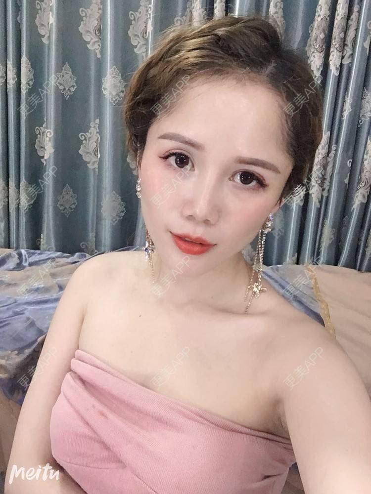更美 - 更美用户RFLSjrNOjT的硅胶丰太阳穴经验 | 硅胶丰太阳穴 | 膨体丰太阳穴 | 太阳穴 | 郑州