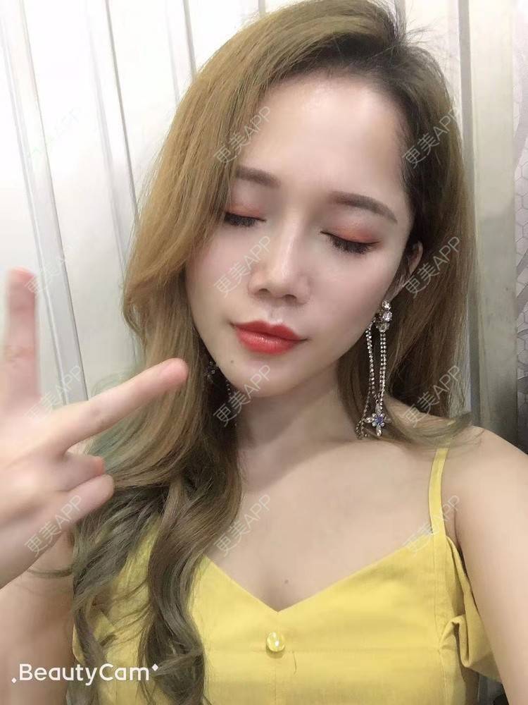 更美 - 更美用户RFLSjrNOjT的硅胶丰太阳穴经验 | 硅胶丰太阳穴 | 郑州