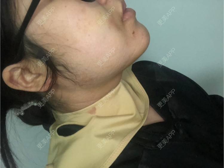 更美 - 更美用户sVz8YXPzuy的吸脂瘦脸经验 | 吸脂瘦脸 | 上海