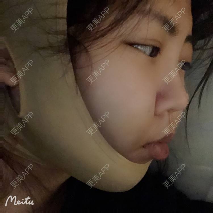 更美 - 更美用户sVz8YXPzuy的吸脂瘦脸经验 | 吸脂瘦脸 | 上海