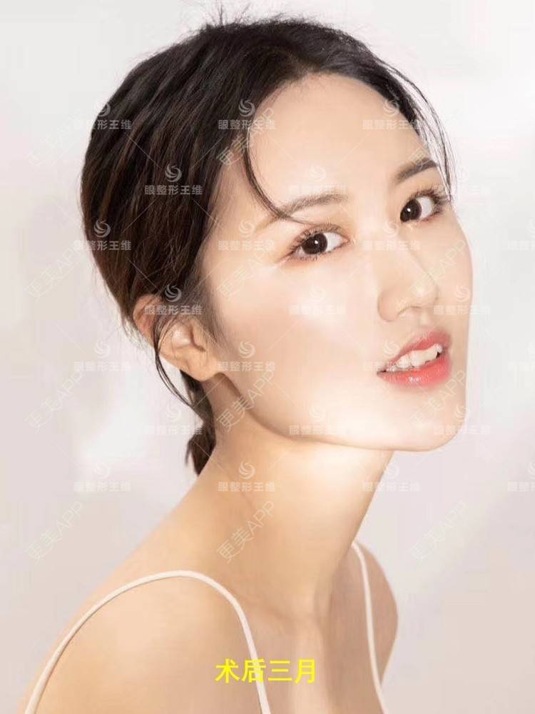 更美 - 陈帅的帅哦的双眼皮修复经验 | 双眼皮修复 | 北京