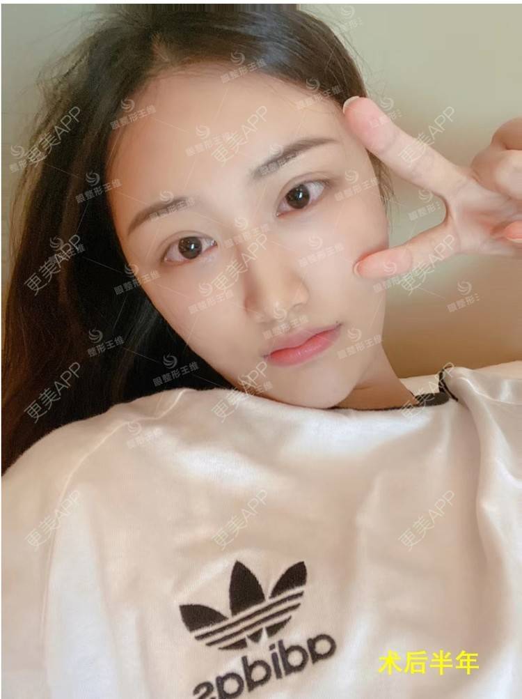 更美 - 陈帅的帅哦的双眼皮修复经验 | 双眼皮修复 | 北京