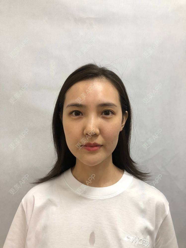 更美 - 更美用户I615A5dR3m的热玛吉经验 | 热玛吉 | 三亚