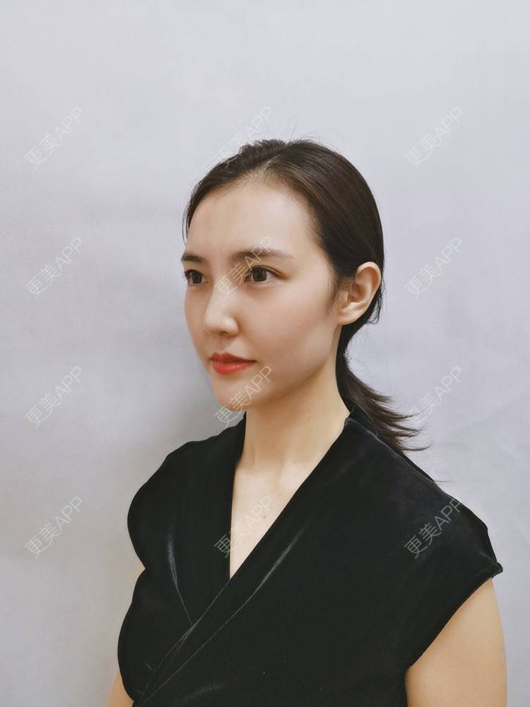 更美 - 更美用户I615A5dR3m的热玛吉经验 | 热玛吉 | 三亚