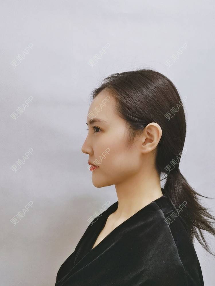 更美 - 更美用户I615A5dR3m的热玛吉经验 | 热玛吉 | 三亚