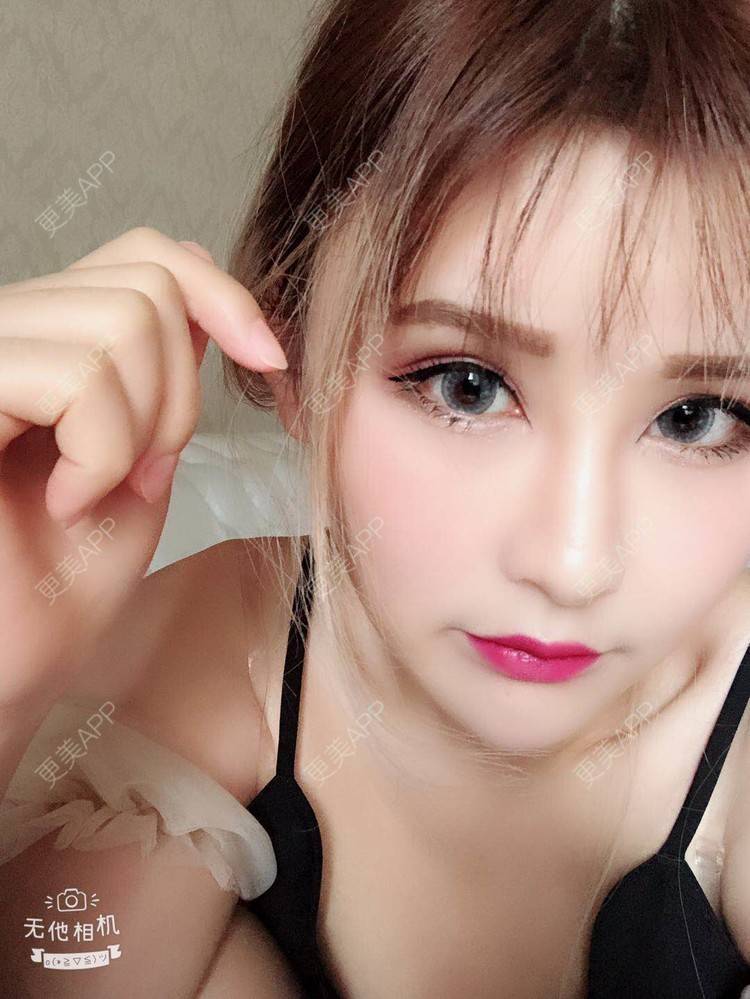 更美 - 阿依古丽💫的全切双眼皮经验 | 视频日记 | 全切双眼皮 | 重庆