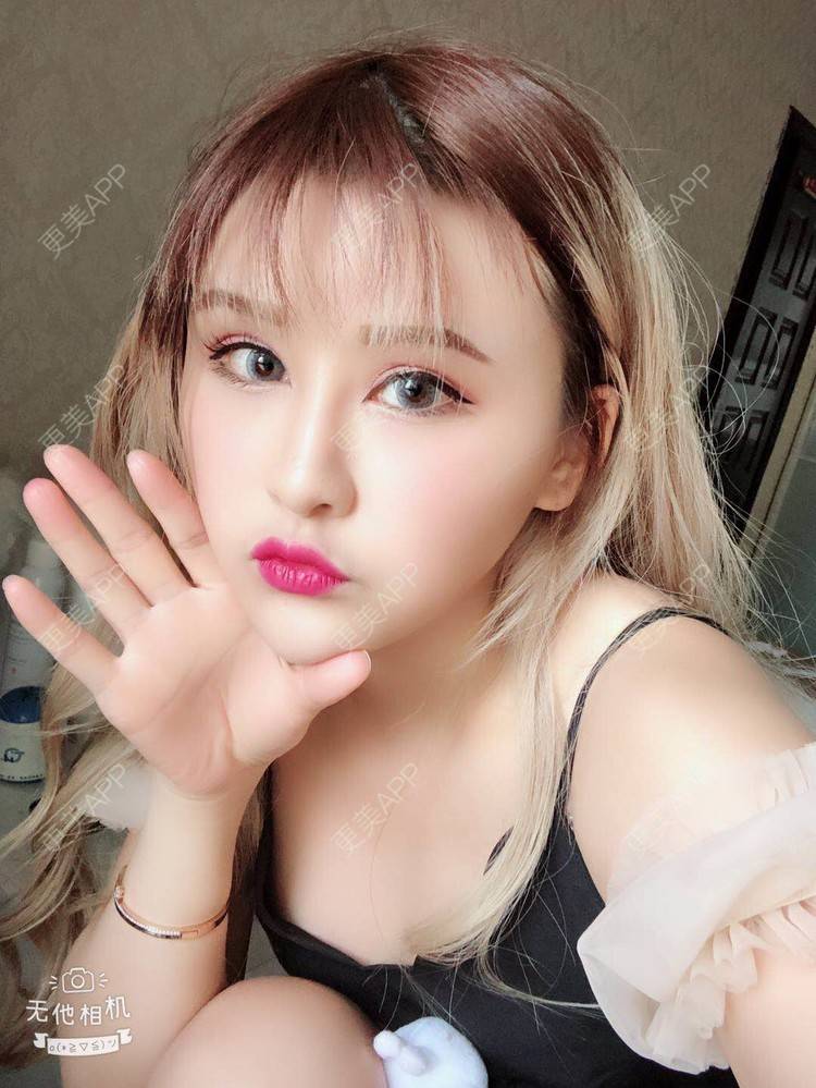 更美 - 阿依古丽💫的全切双眼皮经验 | 视频日记 | 全切双眼皮 | 重庆