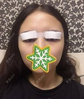 更美 - Fizz瘴的全切双眼皮经验 | 全切双眼皮 | 广州