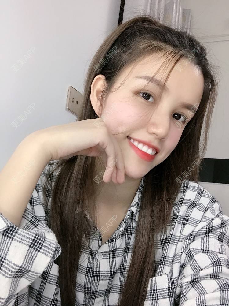 更美 - Lilya果儿的自体脂肪全面部填充经验 | 广州 | 自体脂肪全面部填充