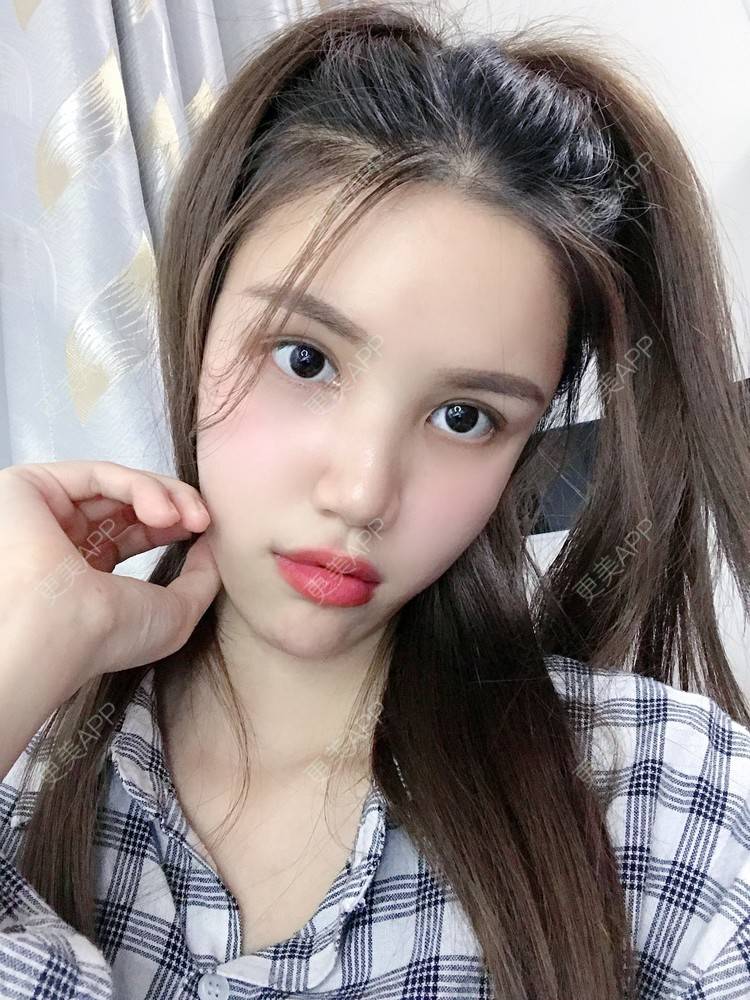 更美 - Lilya果儿的自体脂肪全面部填充经验 | 广州 | 自体脂肪全面部填充