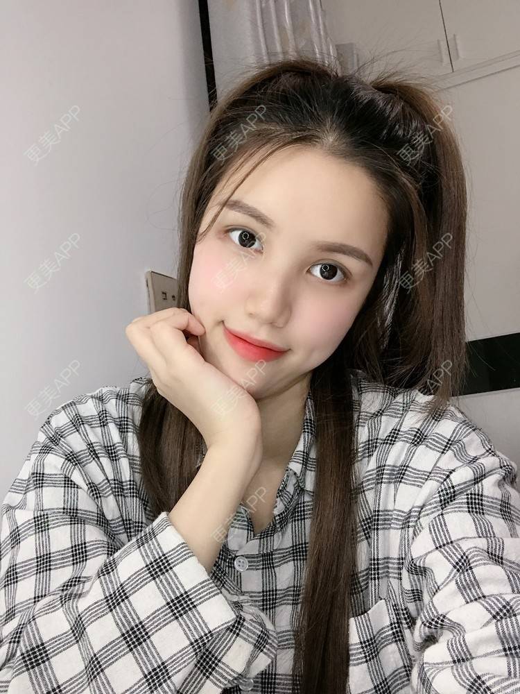 更美 - Lilya果儿的自体脂肪全面部填充经验 | 广州 | 自体脂肪全面部填充