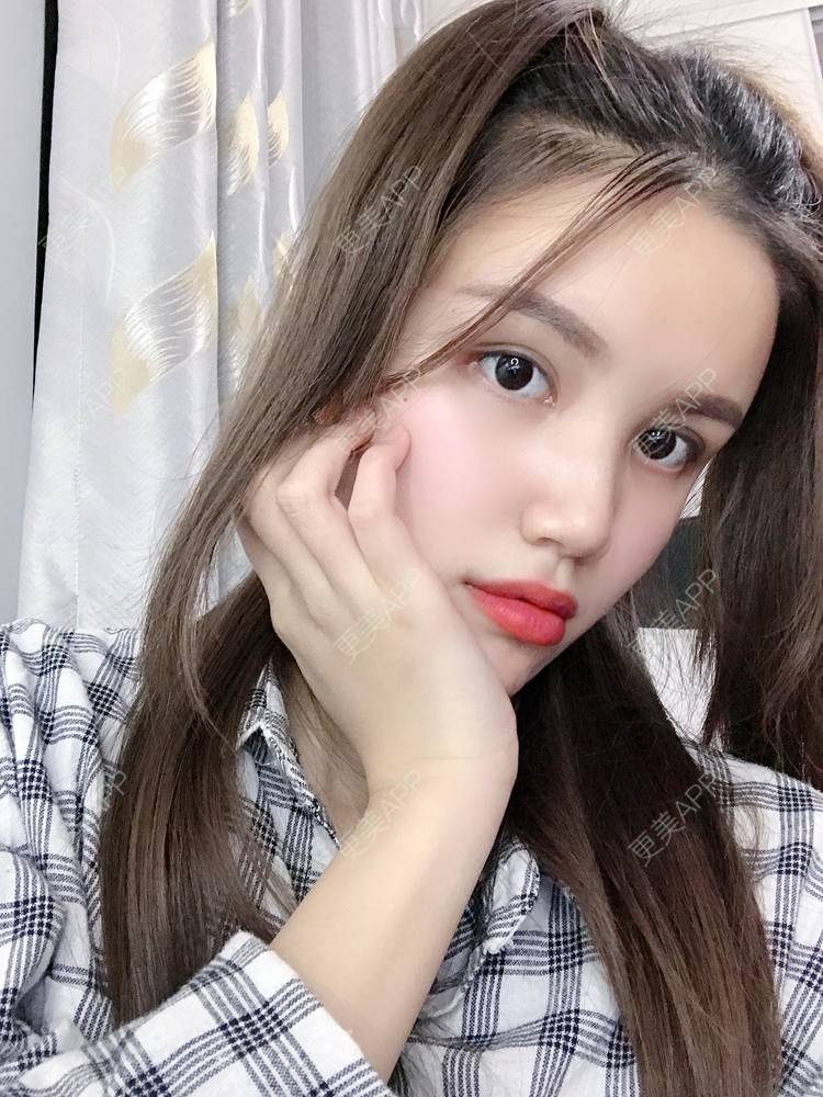 更美 - Lilya果儿的自体脂肪全面部填充经验 | 广州 | 自体脂肪全面部填充