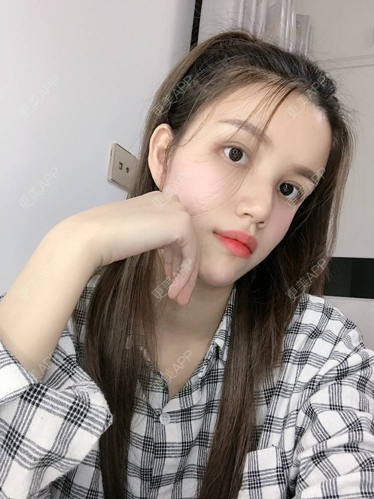 更美 - Lilya果儿的自体脂肪全面部填充经验 | 广州 | 自体脂肪全面部填充