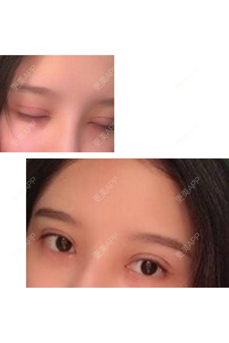 更美 - Fizz瘴的全切双眼皮经验 | 全切双眼皮 | 广州