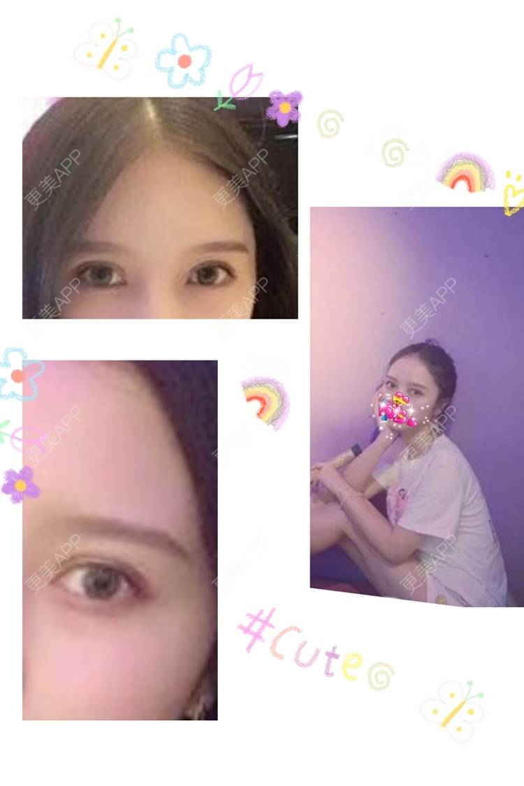 更美 - Fizz瘴的全切双眼皮经验 | 全切双眼皮 | 广州