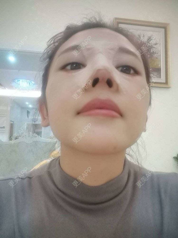 更美 - 更美用户I615A5dR3m的鼻部多项经验 | 鼻部多项 | 三亚