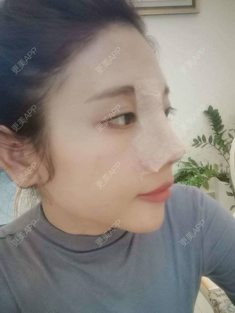 更美 - 更美用户I615A5dR3m的鼻部多项经验 | 鼻部多项 | 三亚