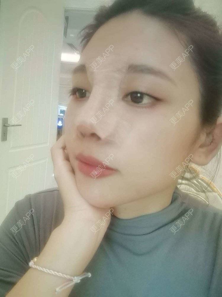更美 - 更美用户I615A5dR3m的鼻部多项经验 | 鼻部多项 | 三亚