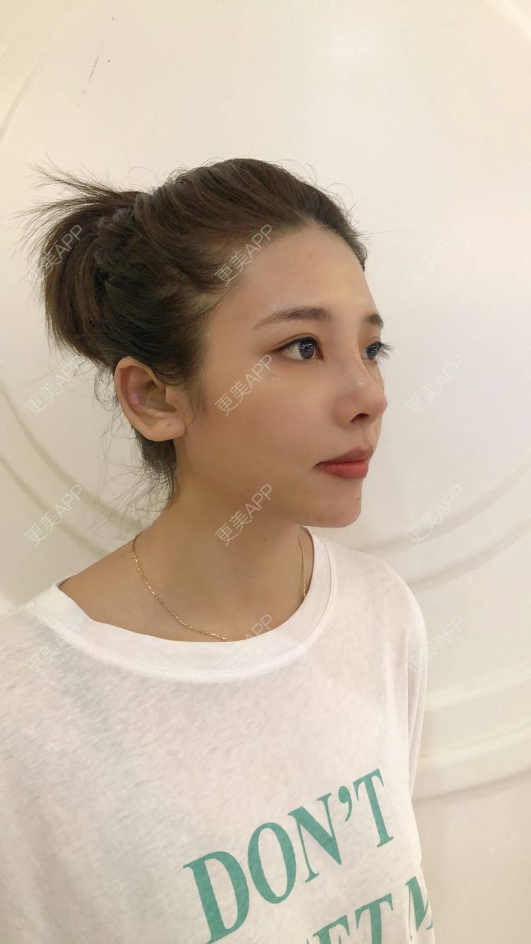 更美 - 更美用户I615A5dR3m的鼻部多项经验 | 鼻部多项 | 三亚