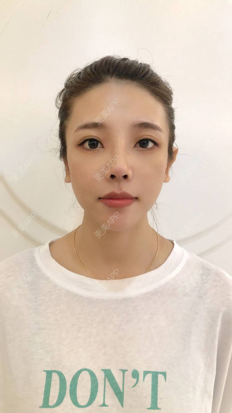 更美 - 更美用户I615A5dR3m的鼻部多项经验 | 鼻部多项 | 三亚