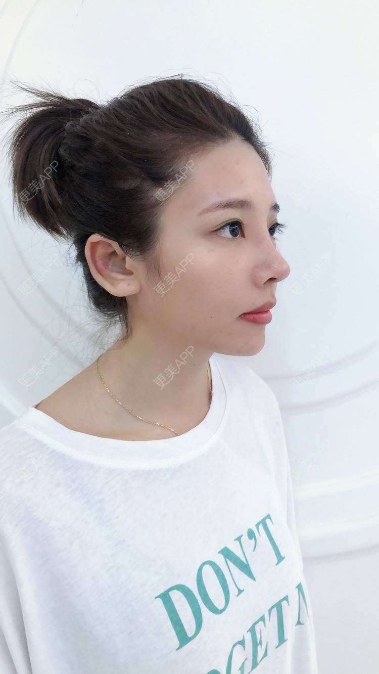 更美 - 更美用户I615A5dR3m的鼻部多项经验 | 鼻部多项 | 三亚