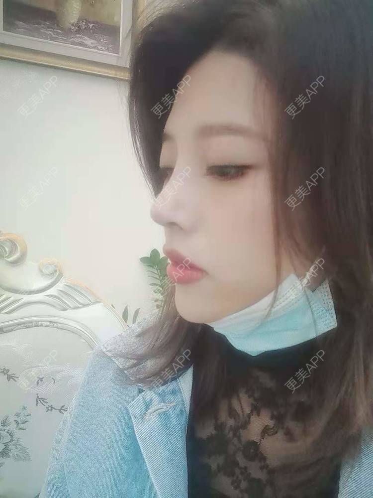 更美 - 更美用户I615A5dR3m的鼻部多项经验 | 鼻部多项 | 三亚