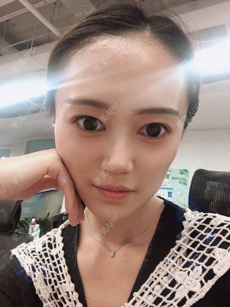 更美 - 午午的下颌角经验 | 成都 | 视频日记 | 下颌角