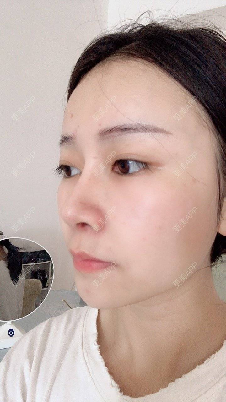 更美 - 冰指、绕温柔慈的膨体隆鼻经验 | 膨体隆鼻 | 北京