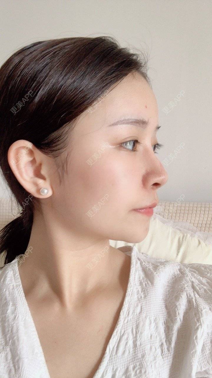更美 - 冰指、绕温柔慈的膨体隆鼻经验 | 膨体隆鼻 | 北京