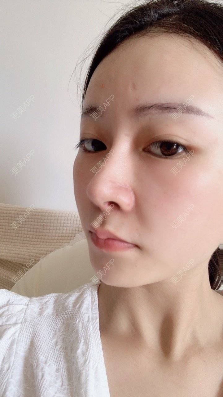 更美 - 冰指、绕温柔慈的膨体隆鼻经验 | 膨体隆鼻 | 北京