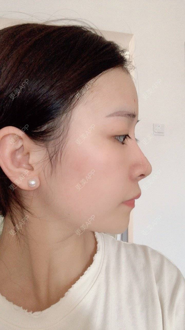 更美 - 冰指、绕温柔慈的膨体隆鼻经验 | 膨体隆鼻 | 北京