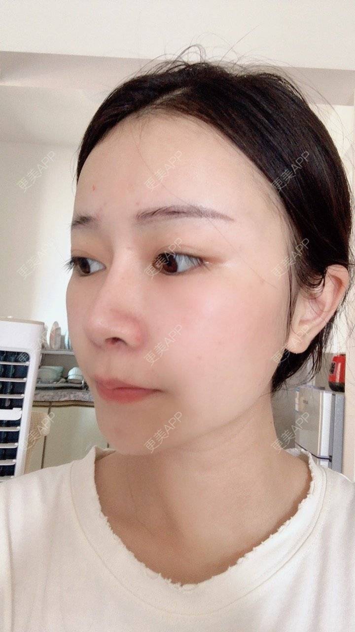更美 - 冰指、绕温柔慈的膨体隆鼻经验 | 膨体隆鼻 | 北京