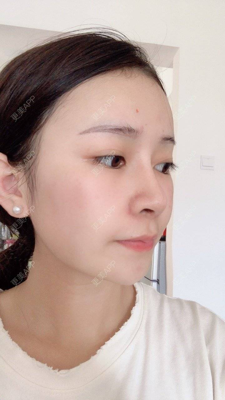 更美 - 冰指、绕温柔慈的膨体隆鼻经验 | 膨体隆鼻 | 北京