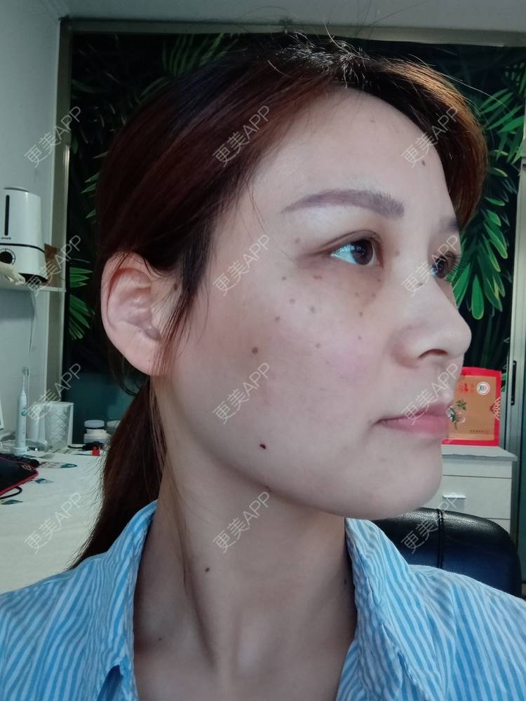 更美 - 星妹子的皮秒激光经验 | 肤质检测 | 皮秒激光 | 北京
